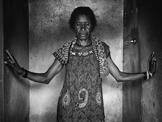 Margret ist Überlebende einer „Hexen“-Verbrennung 2012 in der Nähe von Mendi, südliche Hochebene in Papua Neuguinea